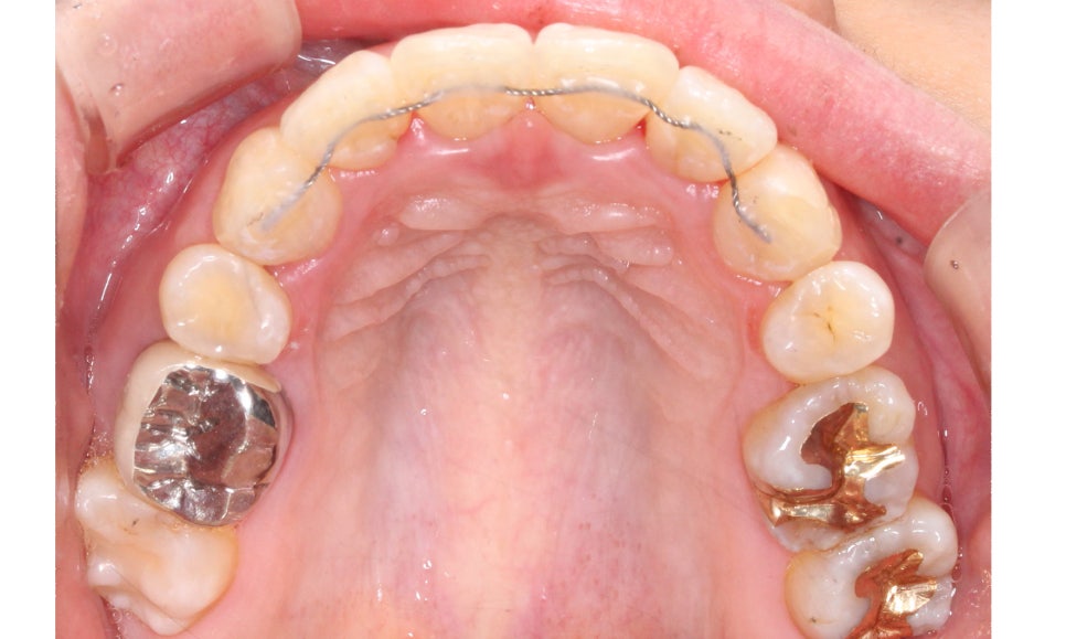 대치동치과 입툭튀 집어넣는 교정 관련 이미지 13