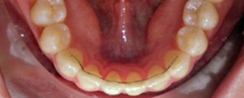 교정끝나고 꼭 안쪽에 유지장치를 붙여야하나요 : 신논현역 투디치과 관련 이미지 1