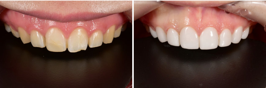 앞니깨짐 라미네이트로 자연스럽게! 관련 이미지 6