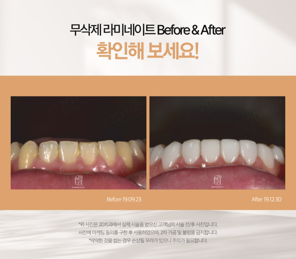 치아무삭제라미네이트 앞니교정 개선을 위해 먼저 해야 하는 것은? 관련 이미지 6