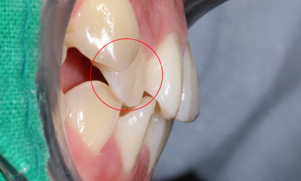 송곳니덧니 교정하는 방법! 관련 이미지 3