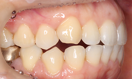 앞니틀어짐 부분교정 완성 후기 관련 이미지 10