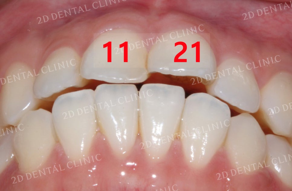 비대칭 앞니, 돌출앞니를 전체 교정으로 교정하고 싶다면!? by.투디치과(2D치과) 관련 이미지 11