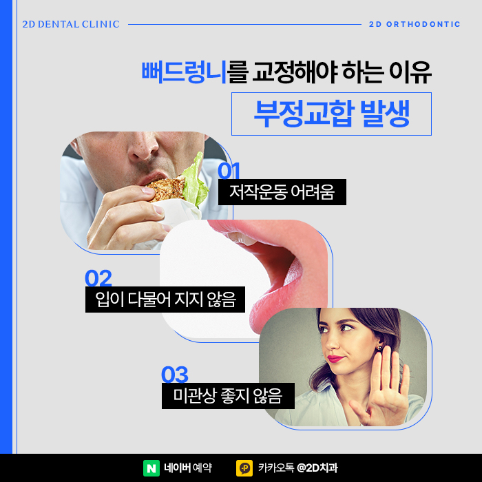 뻐드렁니 고민이라면 강남역 앞니부분교정 잘하는 치과 관련 이미지 3