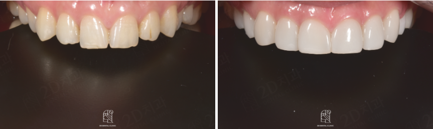 앞니깨짐 라미네이트로 자연스럽게! 관련 이미지 9