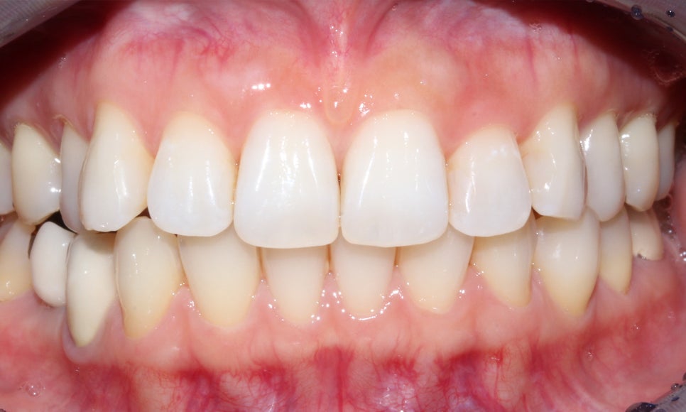 토끼 이빨 치아교정 5개월 교정 완료! by. 투디치과(2D치과) 관련 이미지 12