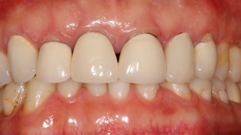 오래된 앞니 블링스로 다시 씌우기 :: 강남역 투디치과 관련 이미지 1