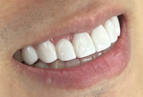 무삭제라미네이트 블랙필름의 장점과 사후관리 관련 이미지 7