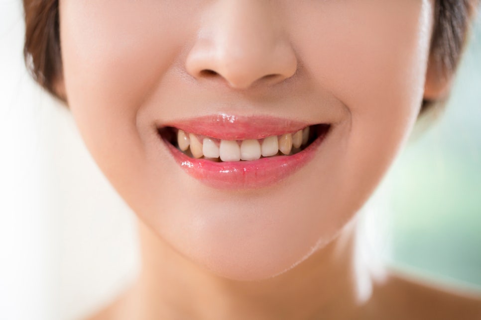 치아착색 없애기 위해서는 관련 이미지 2