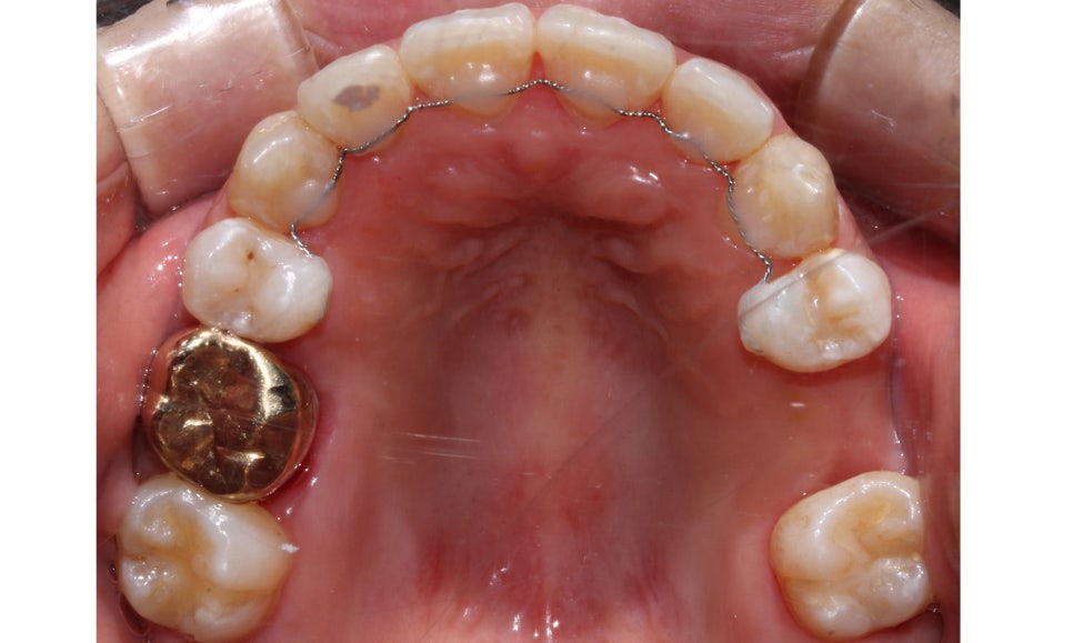 crowding 송곳니덧니 세라믹교정 방법 관련 이미지 13