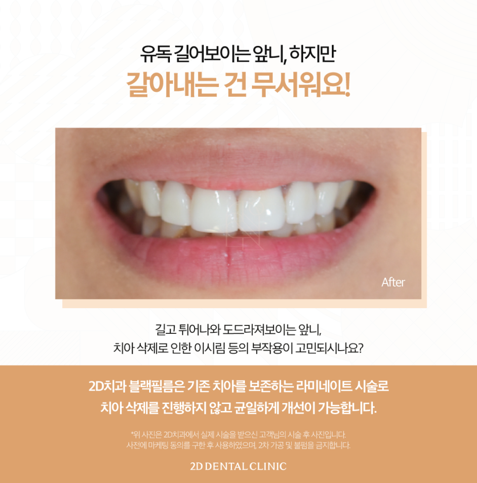 토끼이빨라미네이트 앞니성형으로 단정하고 우아하게 관련 이미지 5