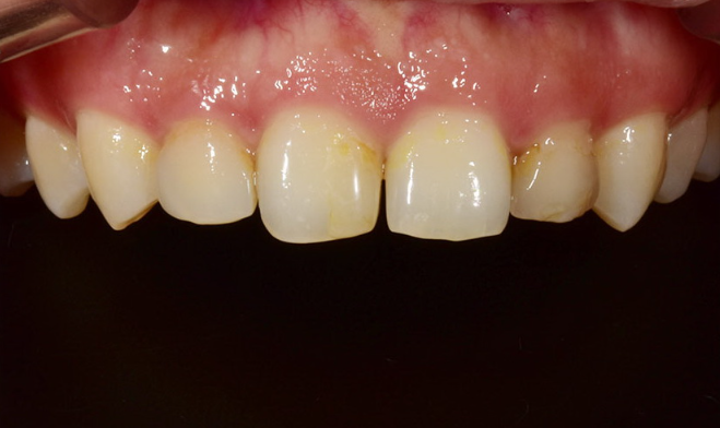 무삭제라미네이트후기가 많은 신논현역 앞니전문병원 2D치과 관련 이미지 8