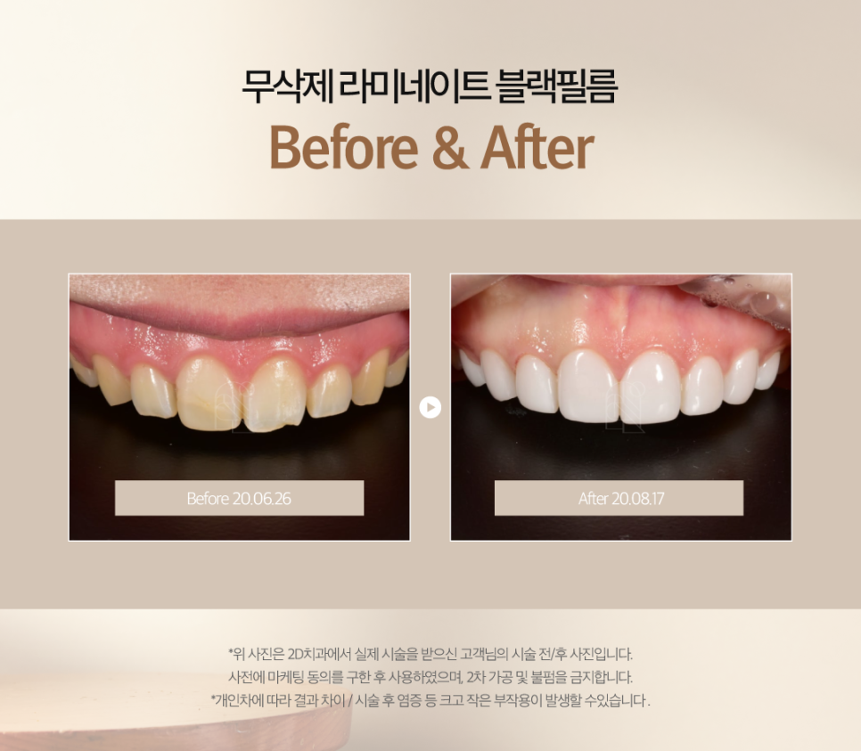 대구무삭제라미네이트 앞니깨짐 보완하며 자연스러움은 그대로! 관련 이미지 7