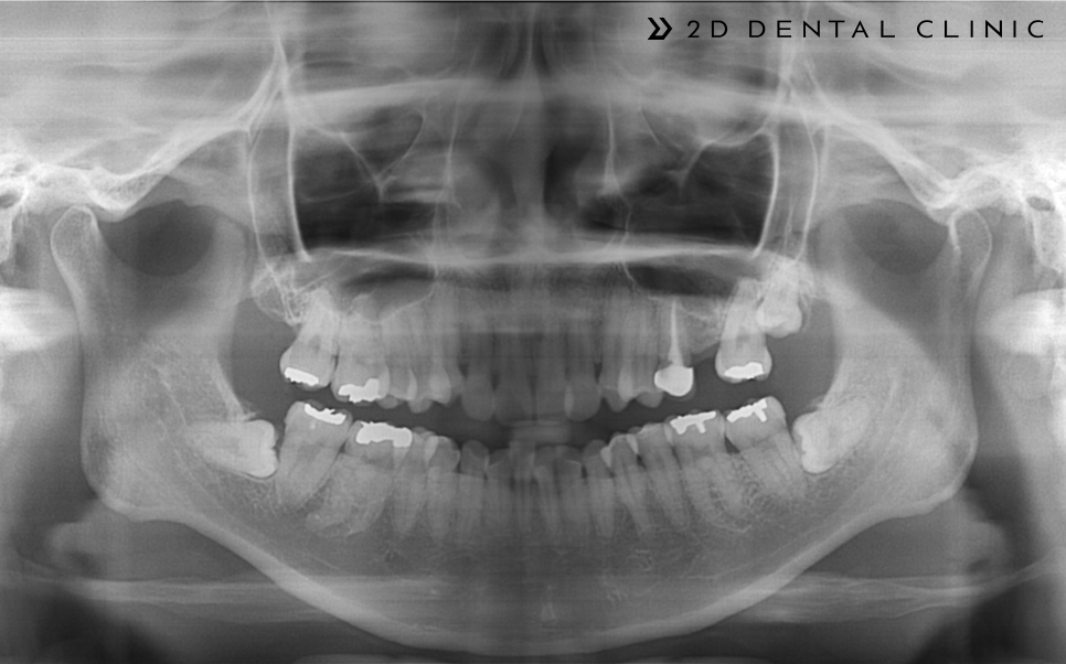 발치교정 돌출입 케이스, 교정전문 2D치과 관련 이미지 4