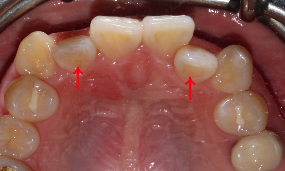 송곳니덧니 교정하는 방법! 관련 이미지 4