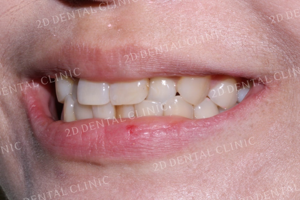 반대교합으로 물리는 치아를 바른 교합으로 교정하기! by.투디치과(2D치과) 관련 이미지 10