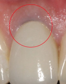 앞니충치 무삭제라미네이트비용 블랙필름 관련 이미지 4