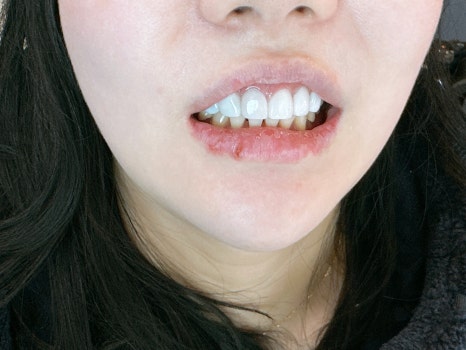 무삭제 라미네이트 개인의 치아디자인에 맞춘 단 하나밖에 없는 치아디자인 블랙필름 관련 이미지 9