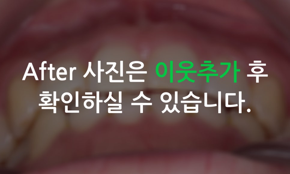 덧니교정 2D교정 (부분교정) 후기 관련 이미지 7