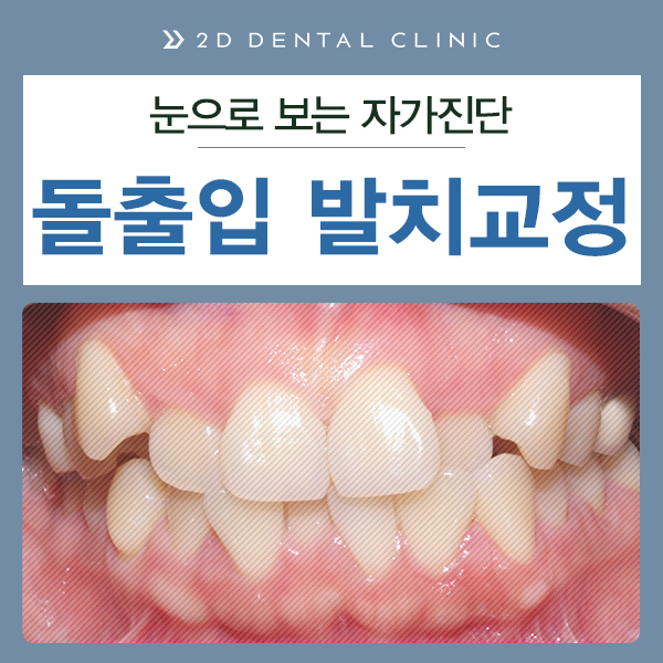 발치교정 돌출입 케이스, 교정전문 2D치과 관련 이미지 2