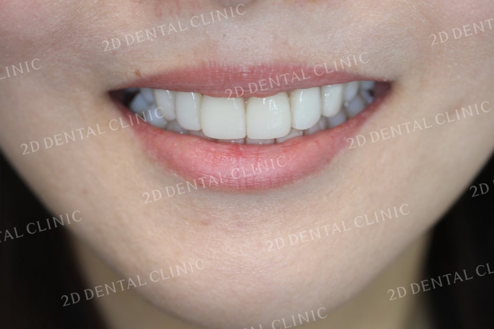 치아틈새를 완벽하게 메꾸자! 블랙트라이앵글 쎄라필름으로 완전 삭제! by.투디치과(2D치과) 관련 이미지 6