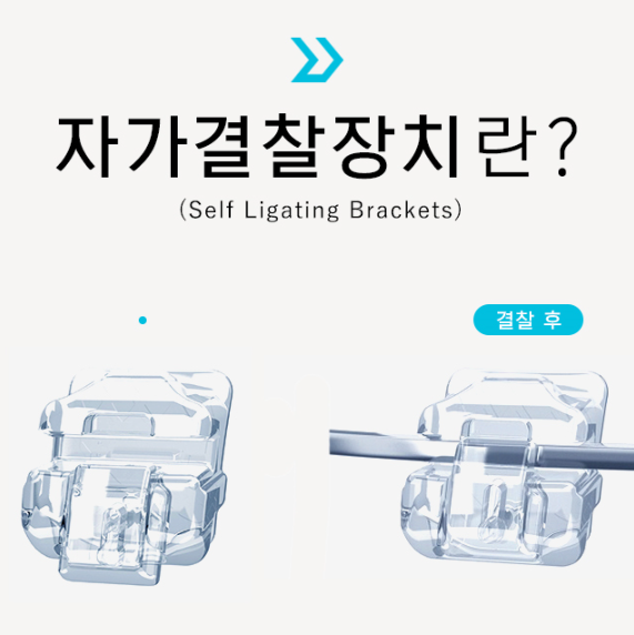 2D교정? 클리피씨? 자가결찰 브라켓! 강남 투디치과 관련 이미지 2