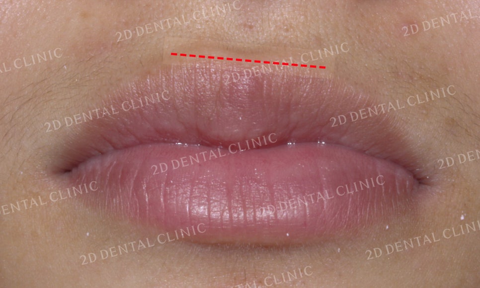 반대교합 치아교정, 앞니를 가지런하게! by.투디치과(2D치과) 관련 이미지 7