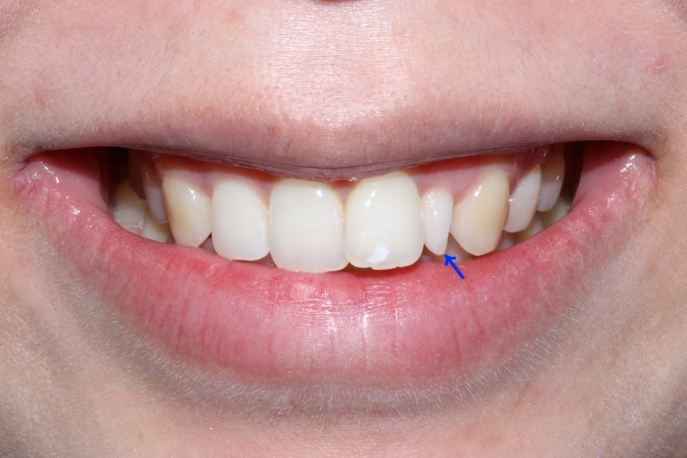 왜소치 뻐드렁니 교정 신논현역치과에서 관련 이미지 2