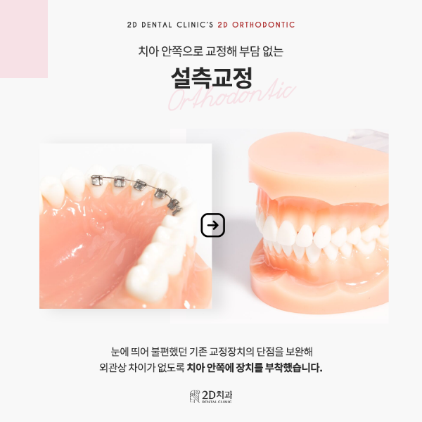 "아무도 모르게 예뻐지자" 티 안나는 <2D교정> 관련 이미지 3