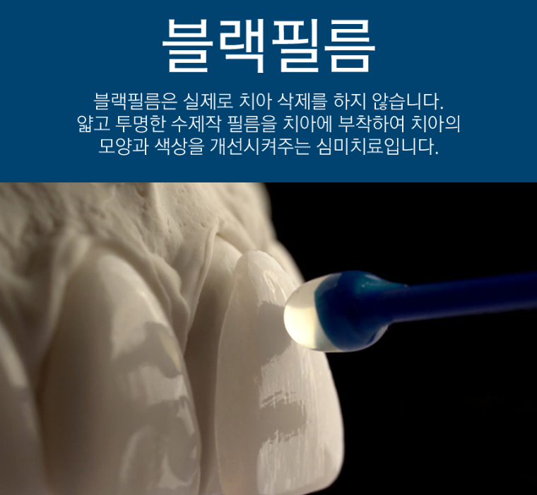 라미네이트잘하는곳 무삭제라미 블랙필름 2D치과 관련 이미지 7
