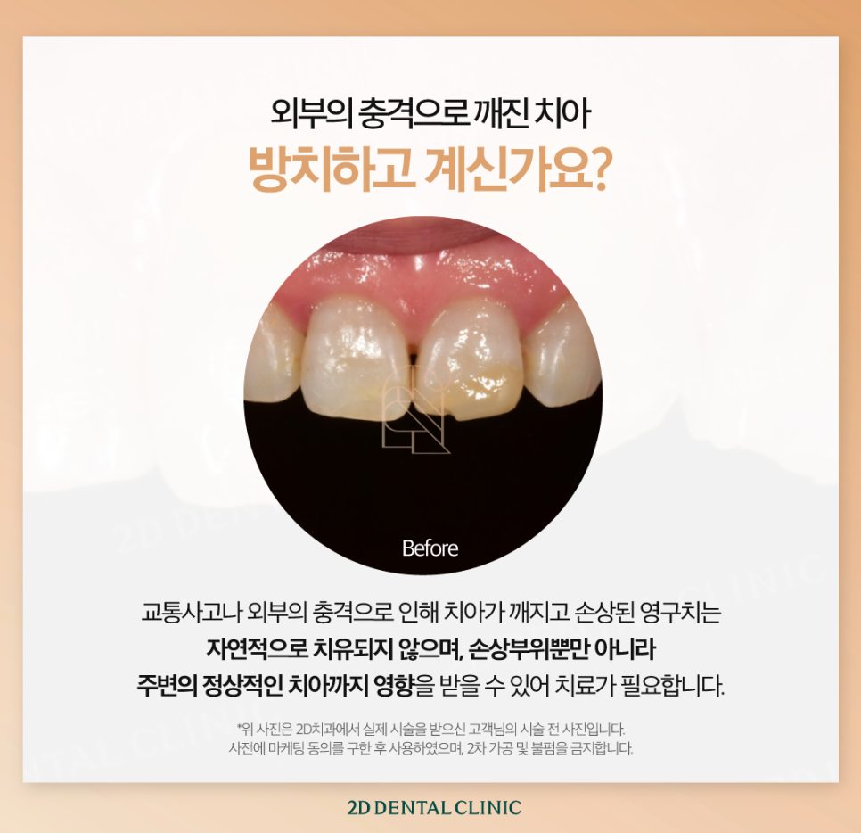 대구무삭제라미네이트 앞니깨짐비용보다 이것에 집중해 주세요! 관련 이미지 3