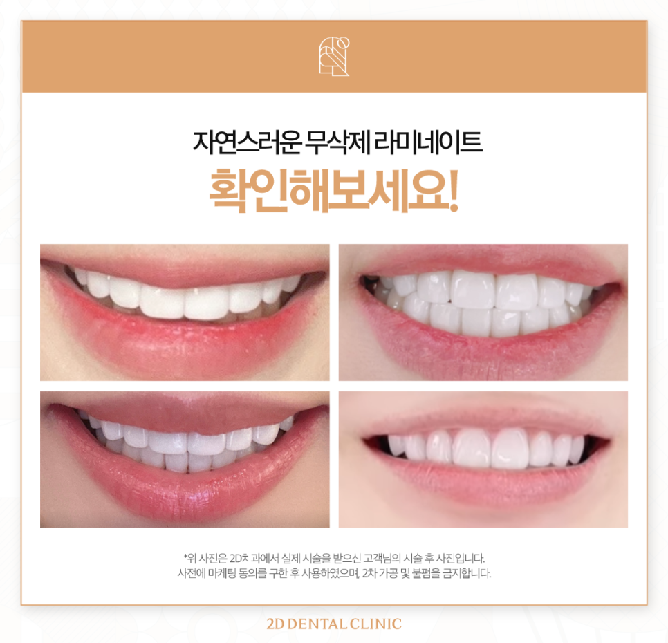 무삭제라미네이트후기 벌어진치아 해결하는 블랙필름 관련 이미지 8