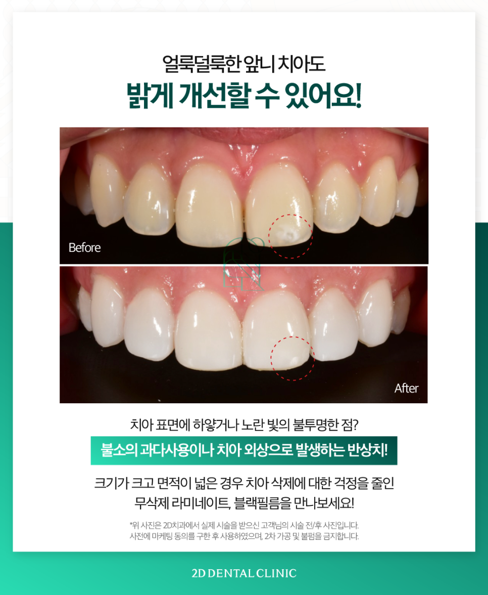 무삭제라미네이트부작용 치아부분변색 얼룩진 앞니 개선 관련 이미지 3