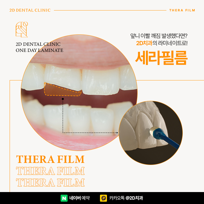 앞니 이빨깨짐 발생했을 때는? 치과라미네이트로! 논현역 세라필름 관련 이미지 1
