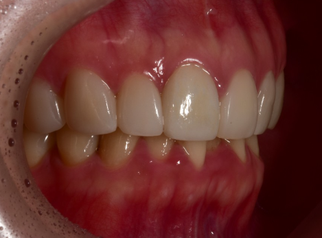 앞니 무삭제라미네이트 고객맞춤형 치아제작하는 블랙필름 관련 이미지 7