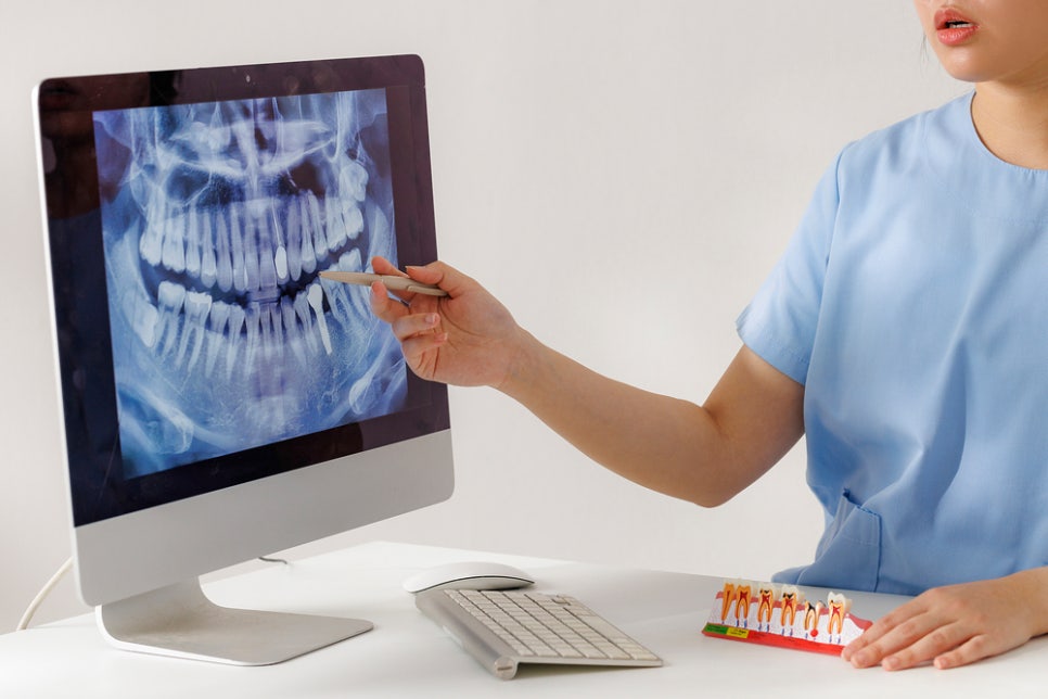 라미네이트뜻부터 시술 후 관리 방법까지 A to Z 관련 이미지 3