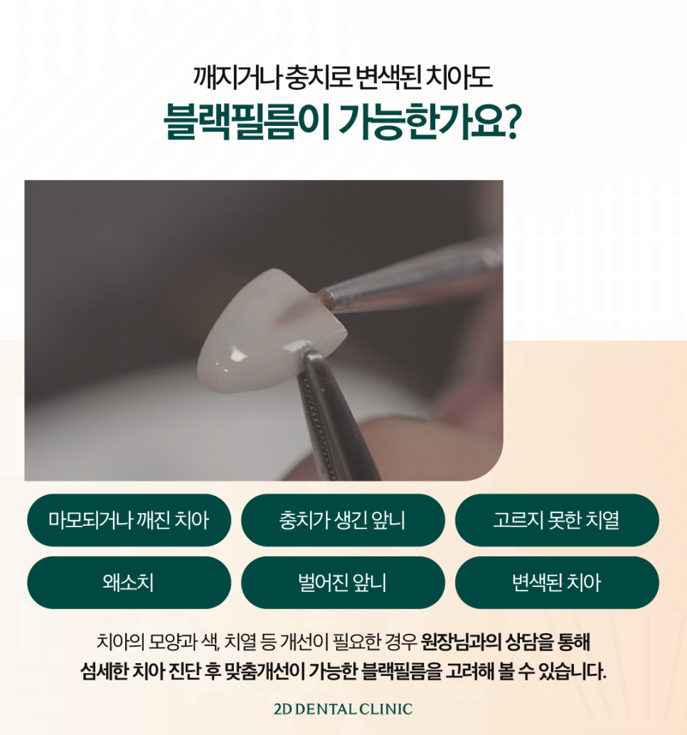광주무삭제라미네이트 앞니심미치료 깔끔한 치아가 그저 부러웠다면 관련 이미지 5