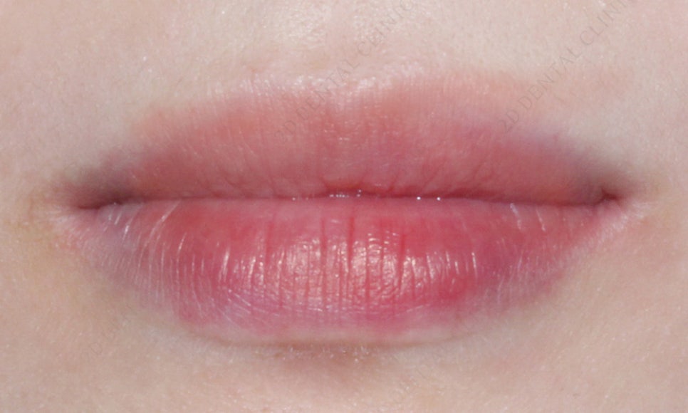 덧니치아 앞니교정 4개월 교정 완료! by. 투디치과(2D치과) 관련 이미지 11