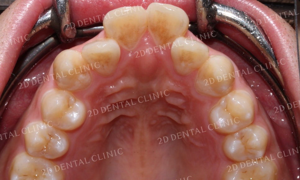 돌출앞니 교정, 튀어나온 입을 넣어보자! by.투디치과(2D치과) 관련 이미지 9