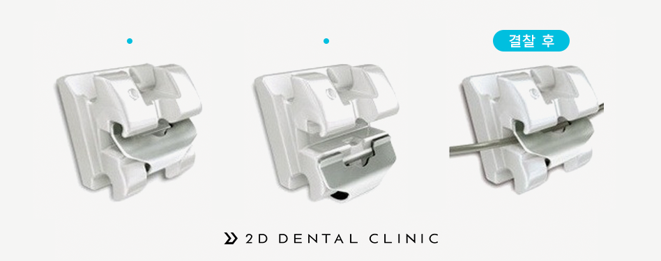클리피씨 교정 가격 얼마일까? 강남 2D치과 관련 이미지 4
