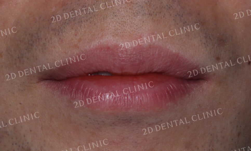 [투디교정] 부정교합 앞니교정을 투디교정으로 고르게! by.투디치과(2D치과) 관련 이미지 8