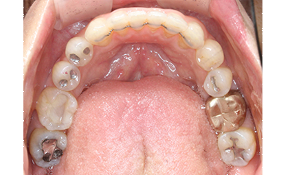 앞니틀어짐 부분교정 완성 후기 관련 이미지 13