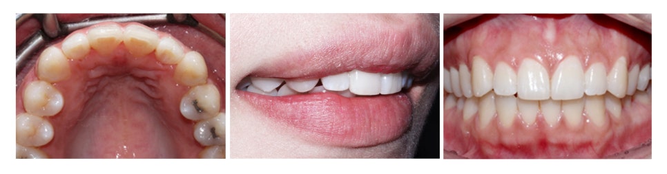 2D치과(투디치과)교정일기 ㅣ 연예인이 많이하는 2D교정 토끼이빨 case 관련 이미지 4