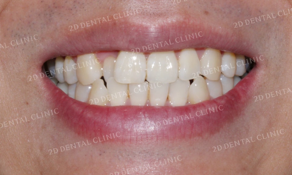 [앞니교정]부정교합교정, 부분교정으로 완성하기! by.투디치과(2D치과) 관련 이미지 3