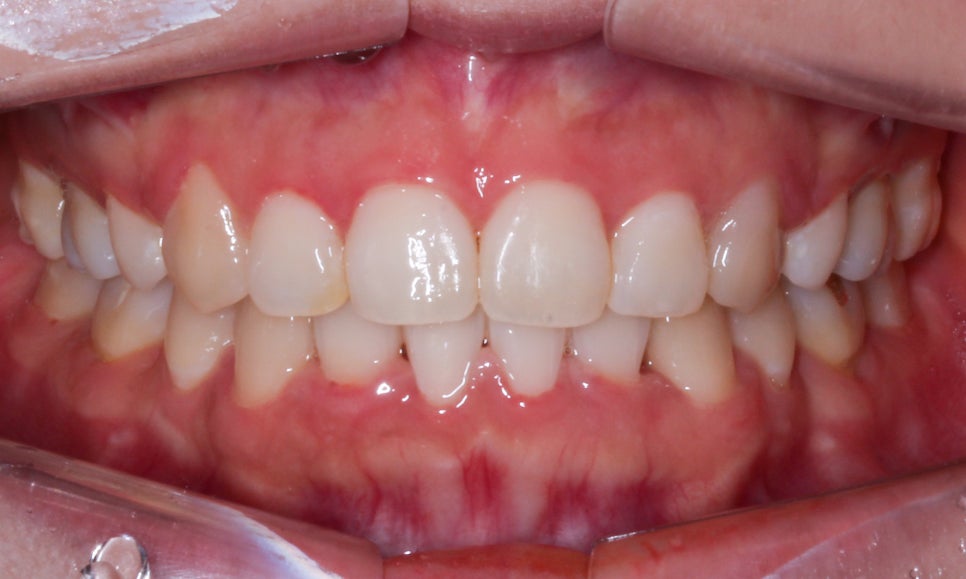 역삼역치과 송곳니덧니 crowding Case 관련 이미지 8