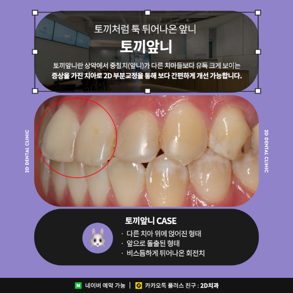 수지처럼 토끼앞니라면? 2D부분교정으로 개선 가능 관련 이미지 2