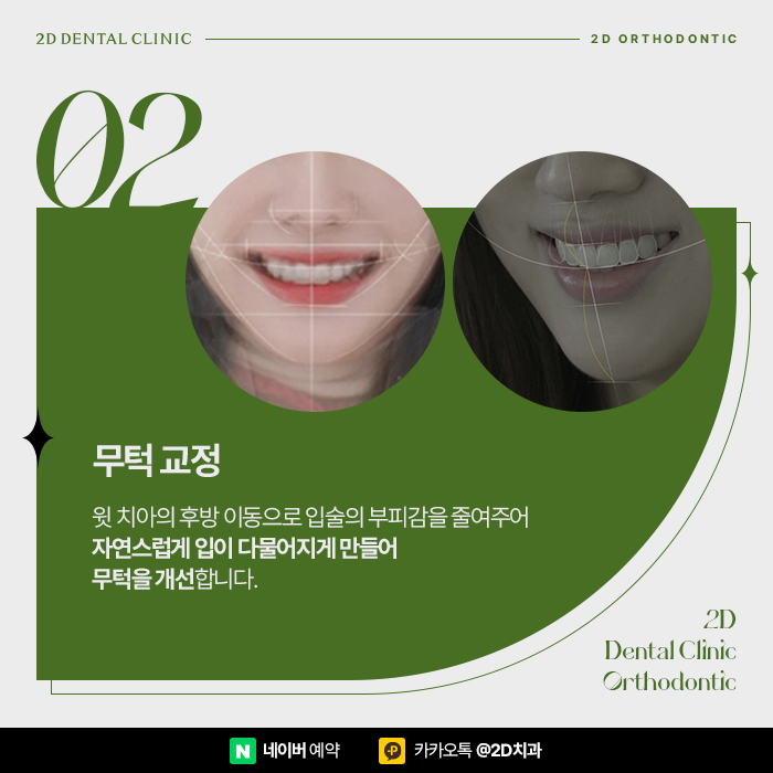 치아교정으로 얼굴형이 바뀔까? 돌출입, 무턱 교정치과 관련 이미지 7