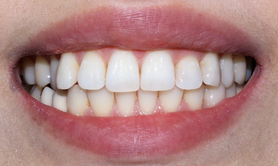 토끼 이빨 치아교정 5개월 교정 완료! by. 투디치과(2D치과) 관련 이미지 8