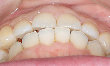 앞니틀어짐 부분교정 완성 후기 관련 이미지 9