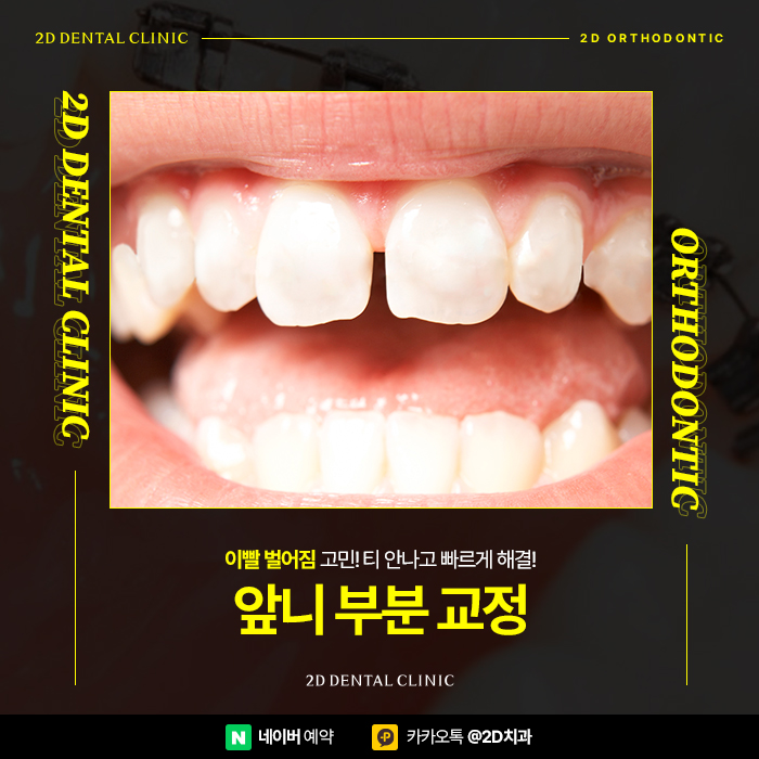 이빨 벌어짐 개선 앞니부분교정가격 비교하고 강남역 부분교정 관련 이미지 1